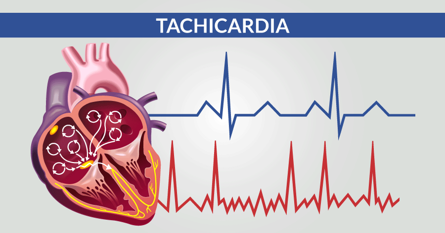 Tachicardia sinusale, quando preoccuparsi? Cause, sintomi, cure, diagnosi